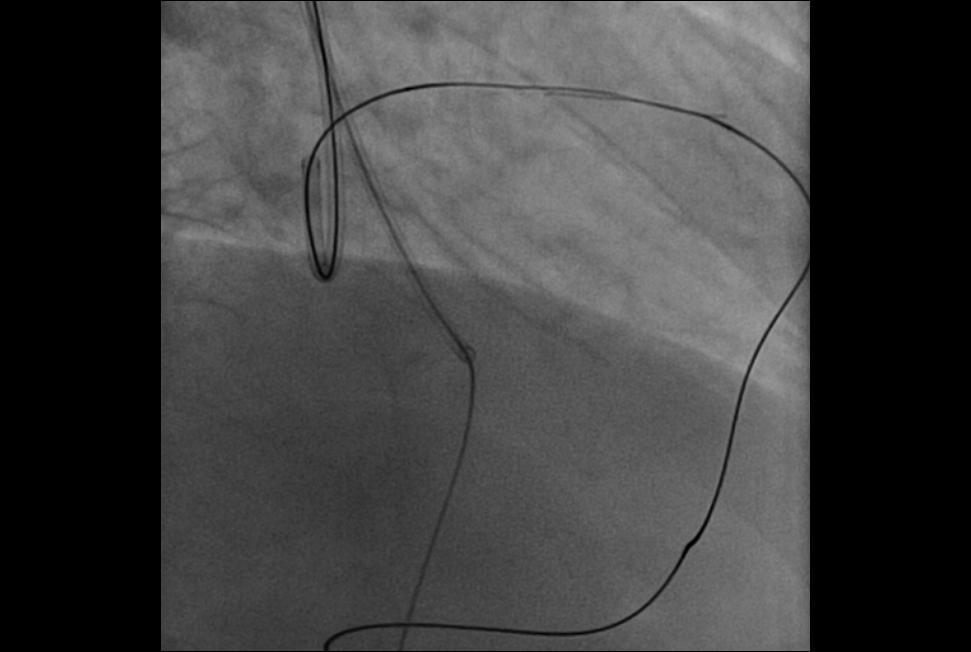 CTO- PCI DOUBLE WIRING TECHNIQUE Antegrade