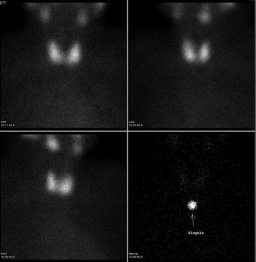 Cosa deve sapere se deve sottoporsi a SCINTIGRAFIA TIROIDEA La scintigrafia Tiroidea è un esame metabolico funzionale per lo studio delle alterazioni funzionali della tiroide già note o sospette.