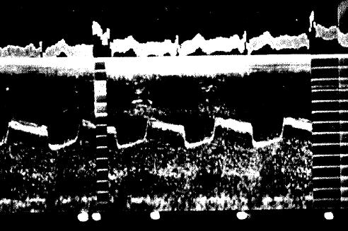 elettrocardiogramma trasduttore tenuto fisso e l