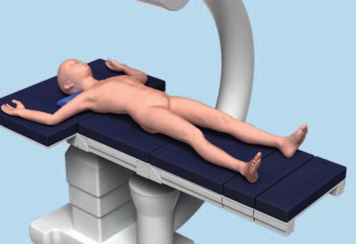 Tecnica chirurgica alternativa Posizionamento del paziente e approccio 1 Posizionamento del paziente 1 Posizionare il