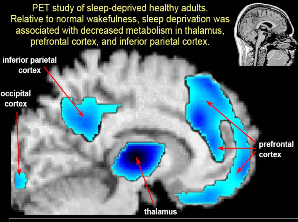 Deprivazione di Sonno Ridotto metabolismo cerebrale nella corteccia