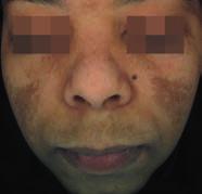 Tipi di iperpigmentazione e loro diagnosi 1-2 melasma HPI (Iperpigmentazione post-infiammatoria) lentigo solari lentigo senili efelidi (lentiggini) Eziologia Forma e distribuzione: Disomogenee ed