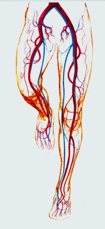 Postulato Criteri di indicazione La P arteriosa precapillare è nell arteriopatia (es. microangiopatia) Paziente in marcia (ortostatismo): 1.