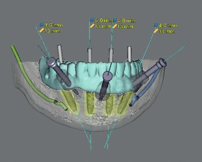 Fast and Easy Loading Procedure (FELP) Sistema di gestione di protesi provvisorie in riabilitazioni computer-guidate a carico immediato Provisional prosthesis management system in immediate loading