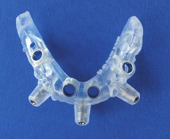 creazione in reverse del modello master si inseriscono nella protesi provvisoria gli stessi sistemi di bloccaggio intra-orale utilizzati per la dima chirurgica in modo semplificare gli aspetti
