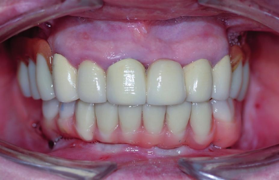 normalmente una dentiera correttamente eseguita e utilizzata dal paziente, che verrà poi trasformata in protesi provvisoria nella fase di carico immediato post-chirurgica.