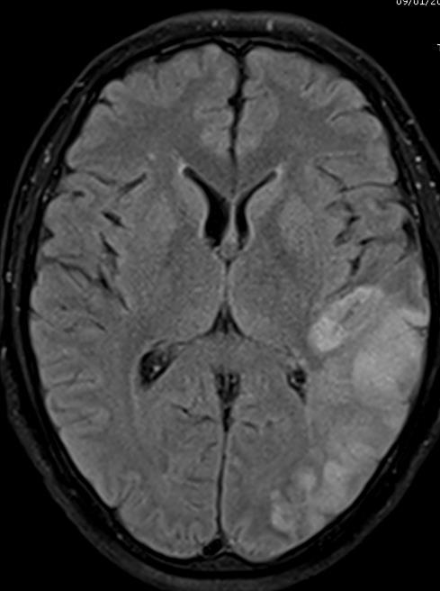 RMN cerebrale (9/01).