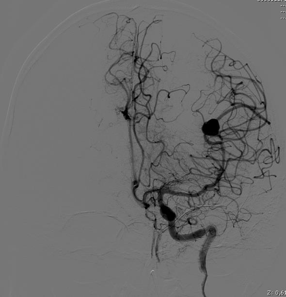 Angiografia: si conferma pseudoaneurisma del ramo parietale M2 dell'arteria