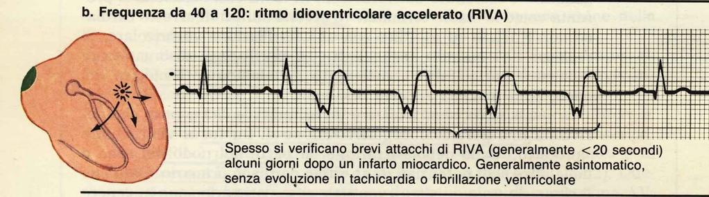 Questa alterazione del ritmo si sviluppa sovente nei primi giorni dopo un infarto miocardico o nelle ore immediatamente successive ad un intervento di rivascolarizzazione (PTCA).