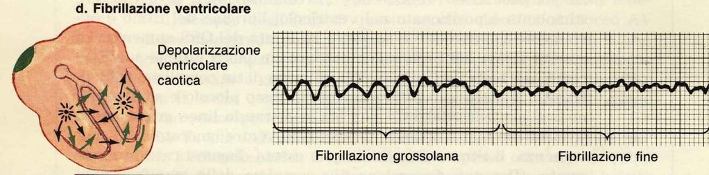 E' un quadro di arresto circolatorio con improvvisa perdita di coscienza e con la morte in pochi minuti, per cui l'avvio immediato di una rianimazione cardiopolmonare, in attesa della defibrillazione