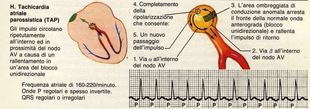 13.4 Tachicardia atriale E' caratterizzata da onde P regolari, identiche, frequentemente inverite in II con frequenza da 160 a 220bat/min.