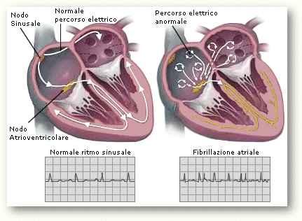 Aspetti clinici: La FA è generalmente un'aritmia cronica associata a cardiopatie. I segni e sintomi dipendono dalla frequenza ventricolare.