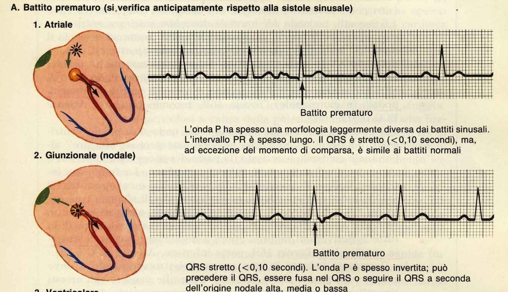complesso QRS.
