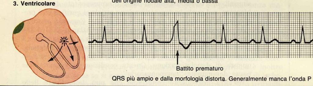 QRS (generalmente con un PR corto), essere in esso inglobato, oppure seguirlo.