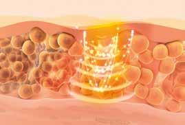 collagene presenti, e una biostimolazione profonda dei fibroblasti nel lungo termine, aumentando la produzione di nuovo collagene e promuovendo il rinnovo dell epidermide.