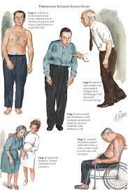 Morbo di Parkinson: Stadiazione Stadio 1: unilaterale Stadio 2: bilaterale senza disturbi dell equilibrio Stadio 3: