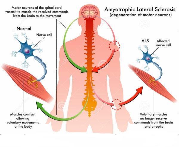 SLA: Cause Fattori genetici: alterazione SOD Alterazioni lisosomiali Glutammato Radicali liberi