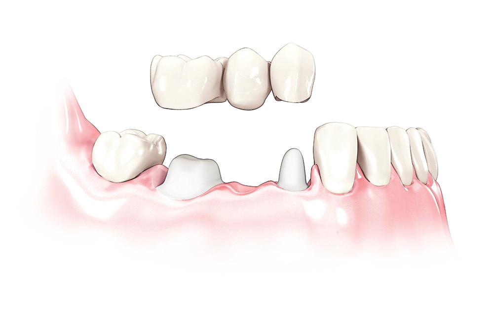 Denti sostitutivi su impianti dentali Gli impianti dentali vengono inseriti nell'osso mascellare e agiscono proprio come le radici dei denti naturali.