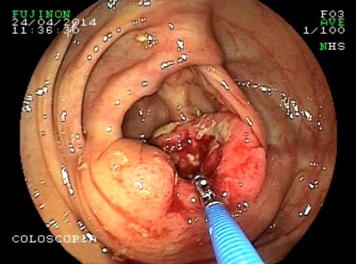 Carcinoma del colon-retto Diagnosi clinica: anamnesi, visita medica generale, esplorazione rettale D i a g n o s i strumentale: colonscopia, biopsia, esame