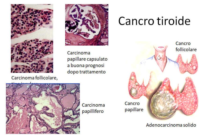 Carcinoma della tiroide Sintomi: nodulo duro Diagnosi clinica: anamnesi, visita medica generale, visita s p e c i