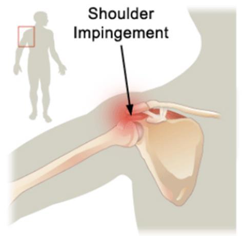 Impossibilità a fare certi movimenti - Riduzione della forza CONFLITTO SUBACROMIALE - Dolore tra