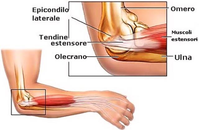 tennista) - Dolore laterale al gomito - Dolore a sollevare pesi -