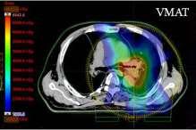 Nucleare Radioterapia