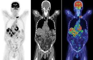 PET/CT High Resolution