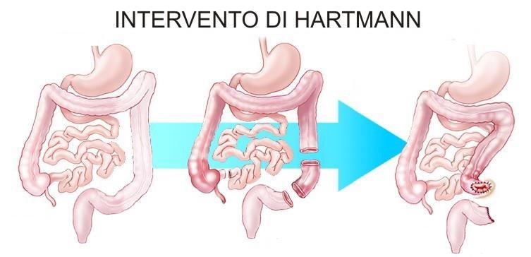 PERFORAZIONE COLICA CON PERITONITE HINCHEY III E IV RESEZIONE