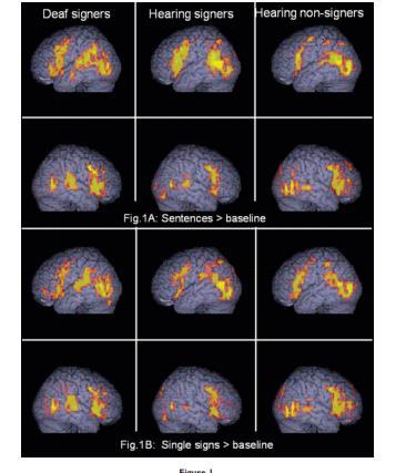 AREE CORTICALI Network cerebrali molto simili coinvolti nell elaborazione del linguaggio parlato e segnato che