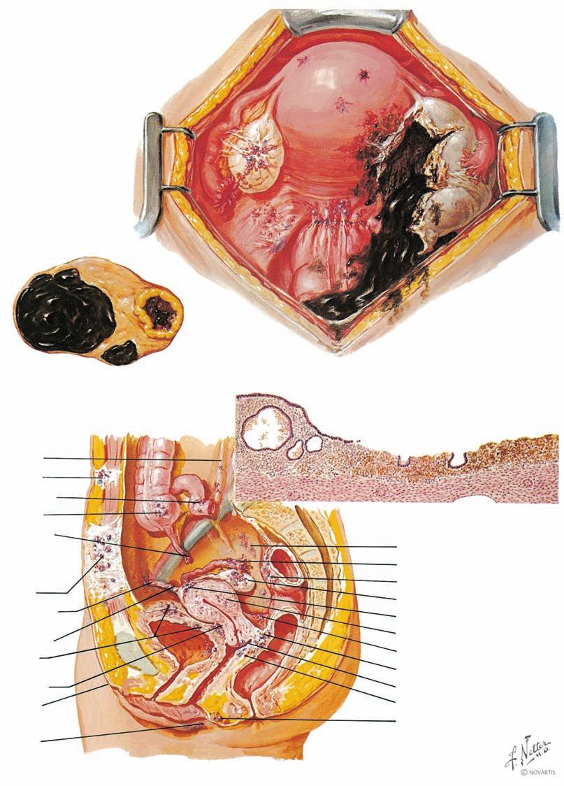 GINECOLOGIA Endometriosi pelvica diffusa: cisti endometriale (cioccolata) rotta Emisezione di un ovaia con cisti endometriali e corpo luteo Sezione microscopica del rivestimento di una cisti