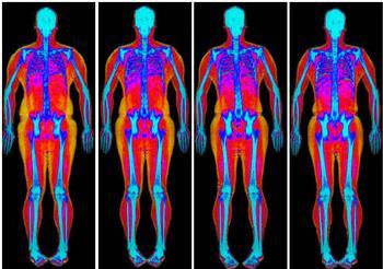 Sarcopenia post-lt Suscettibilità M>F Kalafateli