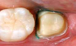 Procedimento pratico Preparazione Dopo la determinazione del colore dentale si
