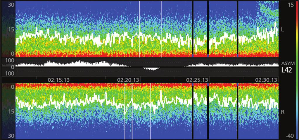 Matrice della densità spettrale (DSA) Comprensione del DSA Bande di frequenza Forme d'onda EEG indicative I periodi di artefatti (ARTF) sono indicati da linee bianche verticali.