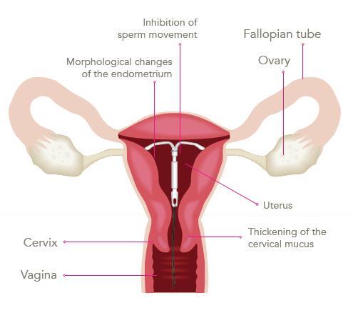 Durante l uso si possono osservare alterazioni morfologiche dell endometrio e una debole reazione locale da corpo estraneo.
