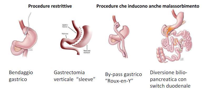 > Procedure restrittive (bendaggio gastrico, gastrectomia verticale) UK/CDC 2016 > Procedure che causano malassorbimento (bypass