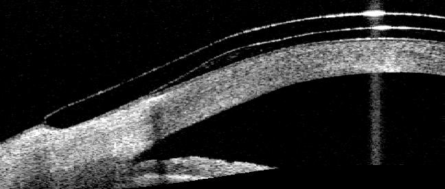 sollevamento del bordo. Un angolo della zona di appoggio corretto posizionerà la linea di congiungimento con la zona inversa davanti alla cornea.