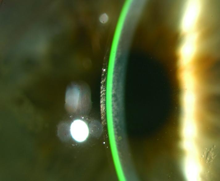 Sezione ottica: La pellicola lacrimale post-lente è all incirca uguale allo spessore della lente (200+ µ). È la situazione ideale alla prima applicazione.