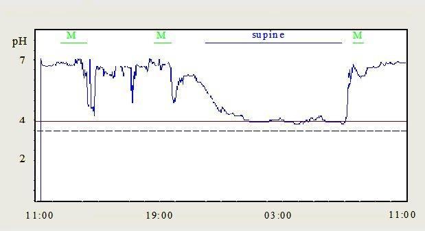 RISULTATI GERD post operatorio Pazienti operati 1001 ph-tested pts. 615 61.