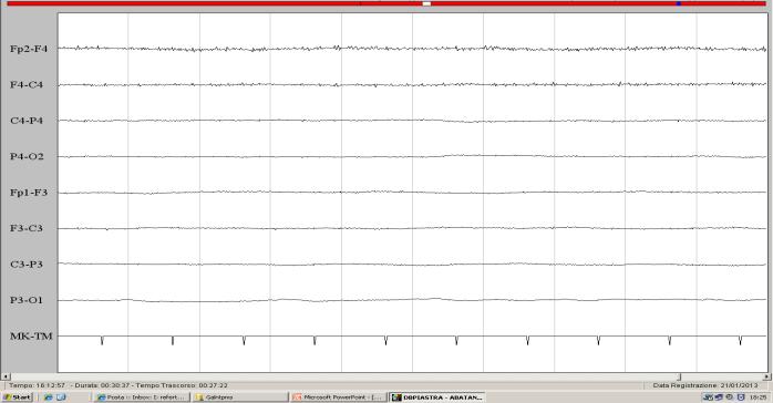 continuo Classificazione patterns EEG non continuo 1. Burst suppression 2.