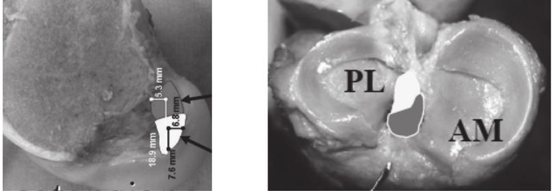 Figura 1a: Footprint femorale LCA Figura 1b: Footprint tibiale LCA La ricerca del posizionamento anatomico del tunnel con la tecnica AM non è priva di complicanze.