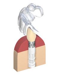 6.6.1 Procedura protesica per componente secondaria provvisoria Straumann VITA CAD-Temp 1 Opzione A: Corona provvisoria avvitata Passaggio 1 Personalizzazione Personalizzare la componente secondaria