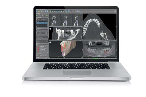 Pianificazione digitale con codiagnostix Questo software diagnostico e di pianificazione 3D è progettato per la pianificazione chirurgica guidata da immagini di impianti dentali, compreso il sistema