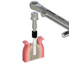 In questo modo le pareti della componente secondaria saranno parallele ai denti o impianti circostanti riducendo le possibilità di complicanze (mancanza di spazio interdentale) durante la fase di