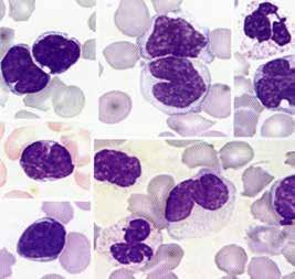 Diagnosi richiede la presenza nel periferico di almeno 1000 Sèzary cells/mm 3 Cellule T con