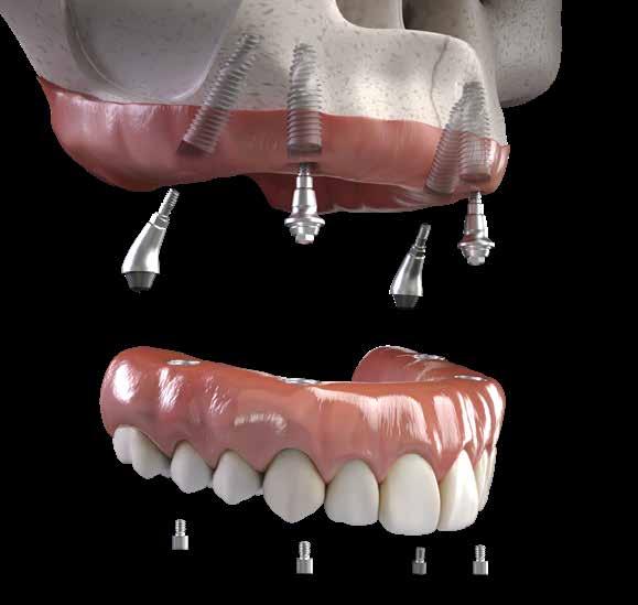 Neodent NeoArch Un sorriso per tutti. Soluzione fissa immediata per arcata completa.