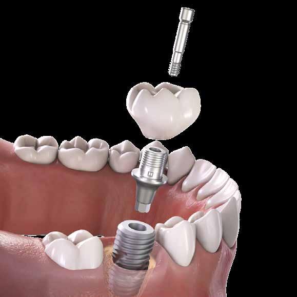 Soluzione per impianti posteriori Inserimento immediato in alveolo post-estrattivi in situazion cliniche complesse; Iserimento immediato dell