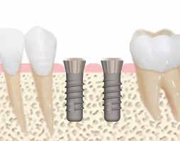 Se il paziente risulta idoneo, si procede alla pianificazione chirurgica scegliendo accuratamente l impianto ideale per qualità e quantità di osso, valutando accuratamente carico masticatorio e resa