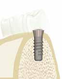 Per definire le fasi è consigliabile eseguire le seguenti operazioni: Ceratura diagnostica su modello; Analisi di valutazione del piano occlusale; Definizione del tipo di sovrastruttura;