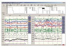 Elettroencefalografo Computer e software Computer di tipo normale possono essere utilizzati in attrezzature mediche.